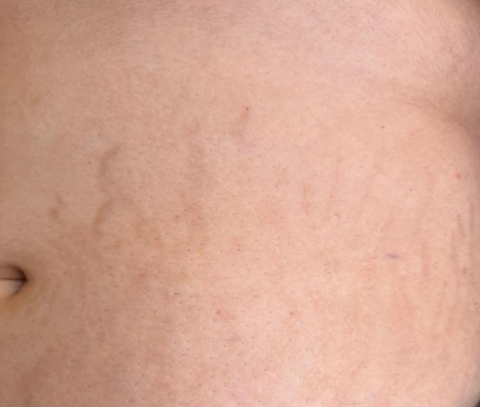 Antes del tratamiento de estrías - DermaPrime Rancagua