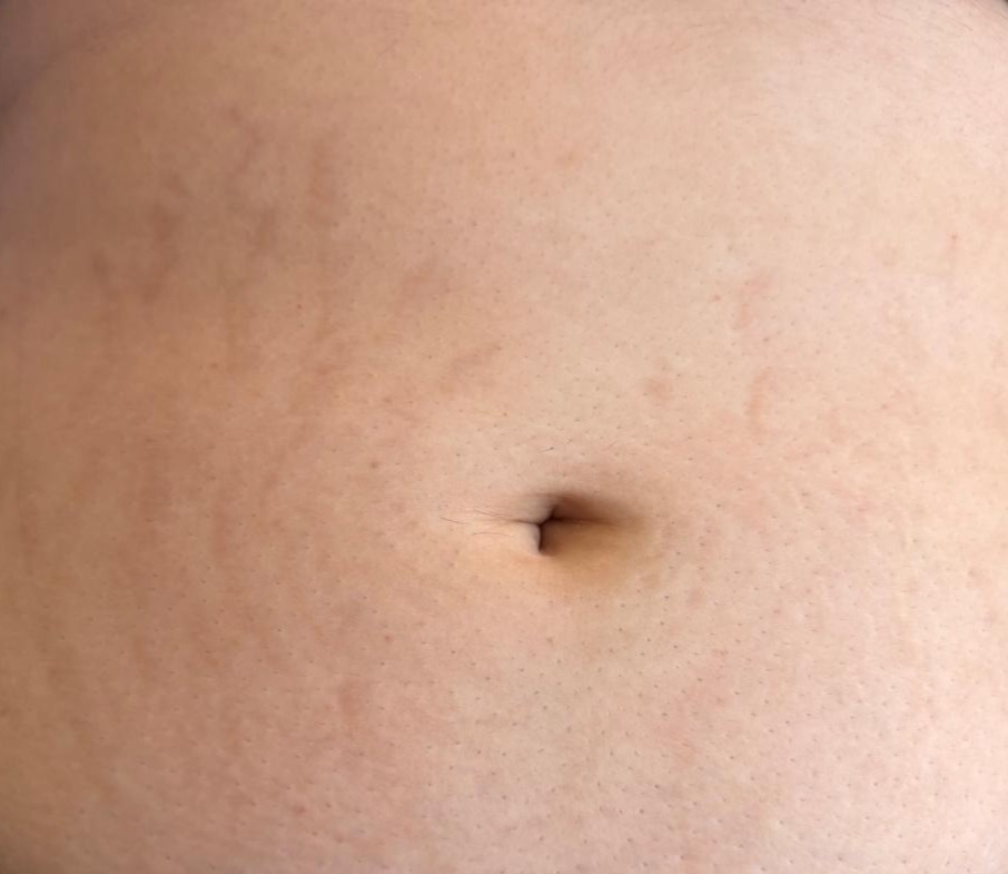 Antes del tratamiento de estrías - DermaPrime Rancagua