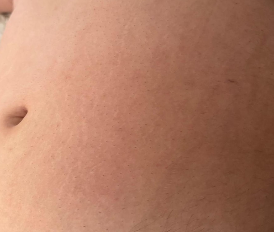 Después del tratamiento de estrías - DermaPrime Rancagua