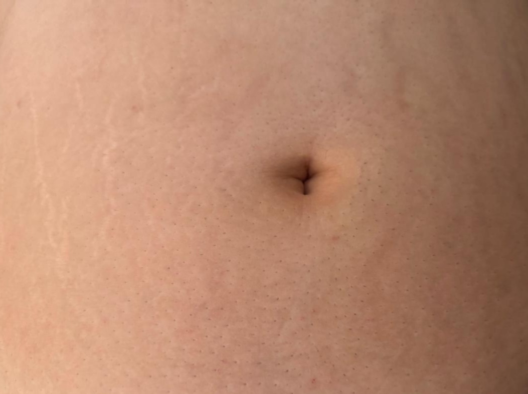 Después del tratamiento de estrías - DermaPrime Rancagua